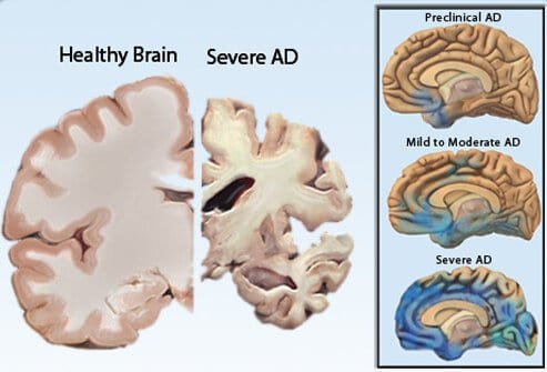 Dementia brain